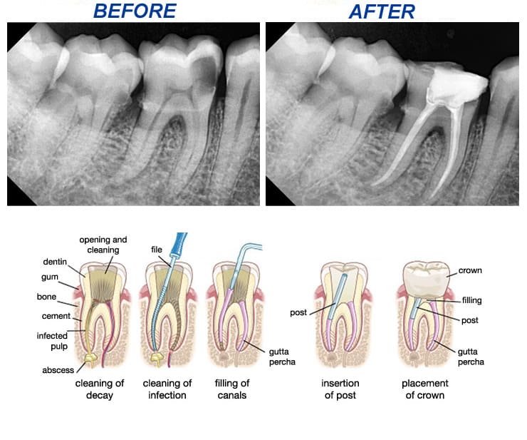 Albums 98+ Wallpaper Root Canal X-ray Before And After Stunning
