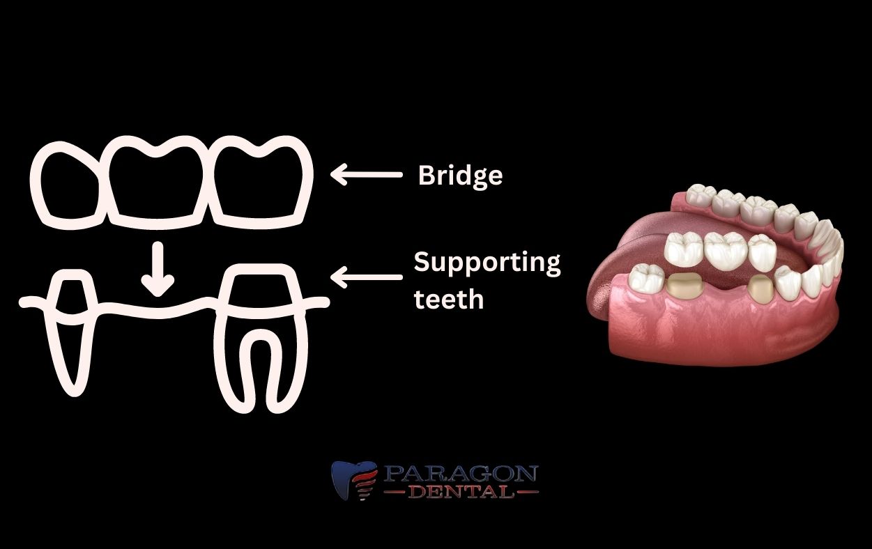 Effects Of Missing Teeth 3 Ways To Replace Them   5 1 