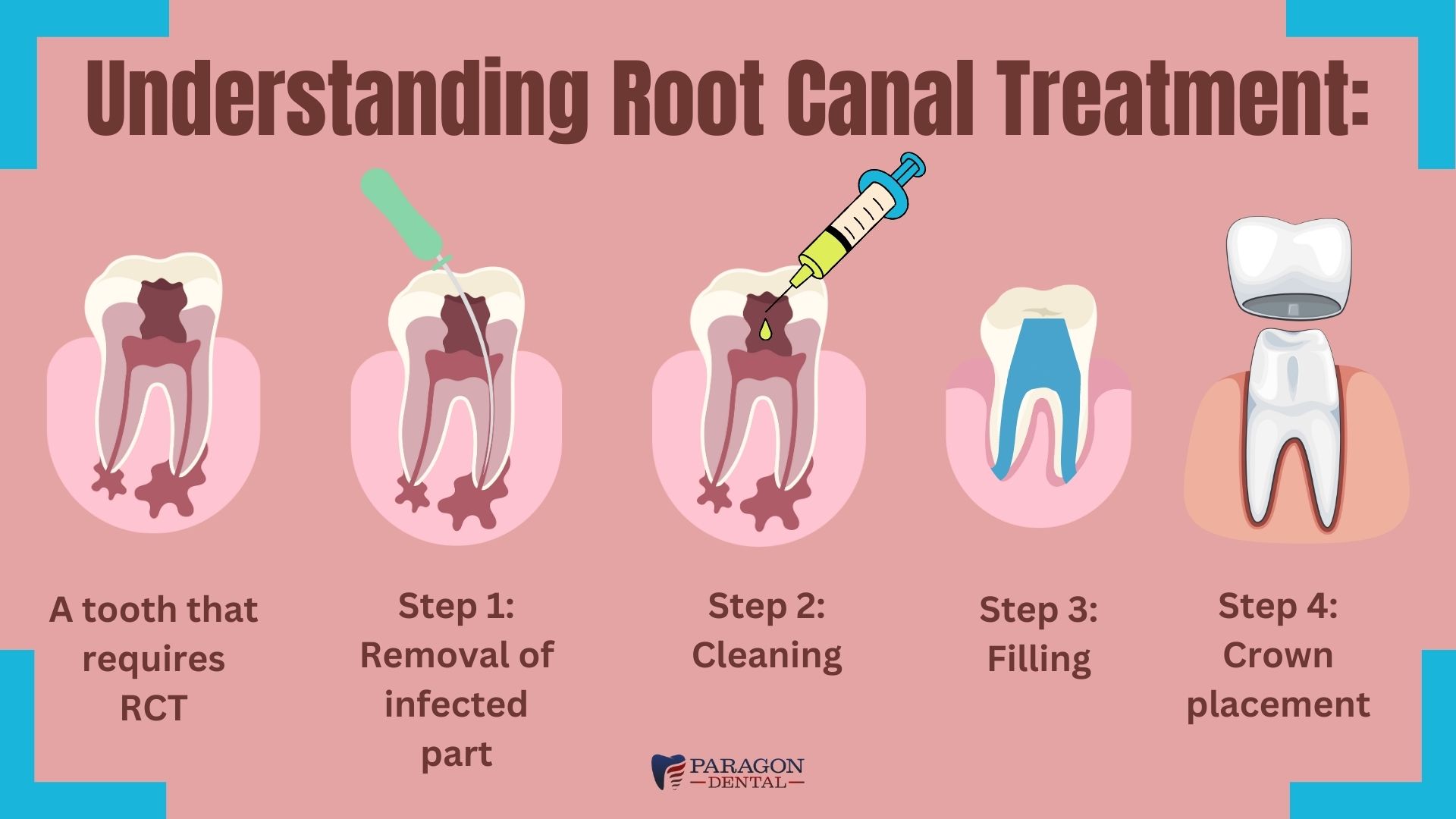 The Importance Of Dental Crown After Root Canal Treatment