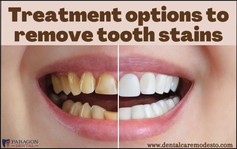 7 Treatment Options to Erase Tooth Stains - Paragon Dental